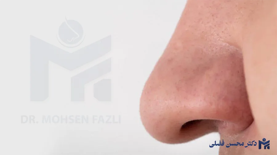 تغییرات قوس بینی پس از جراحی؛ راهنمای کامل و جامع مراقبتی