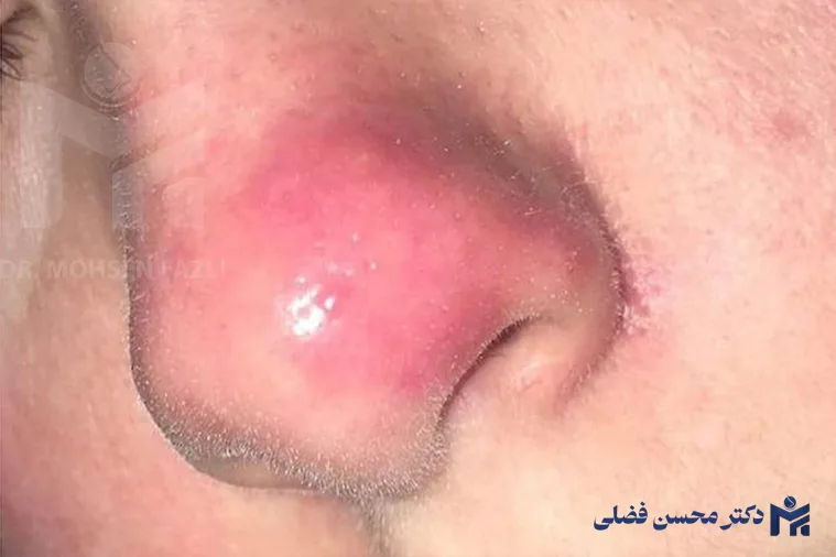 تغییرات قوس بینی پس از جراحی؛ راهنمای کامل و جامع مراقبتی